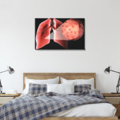 ぜんそく発作の間の気道の炎症 キャンバスプリント (インサイチュ (寝室))