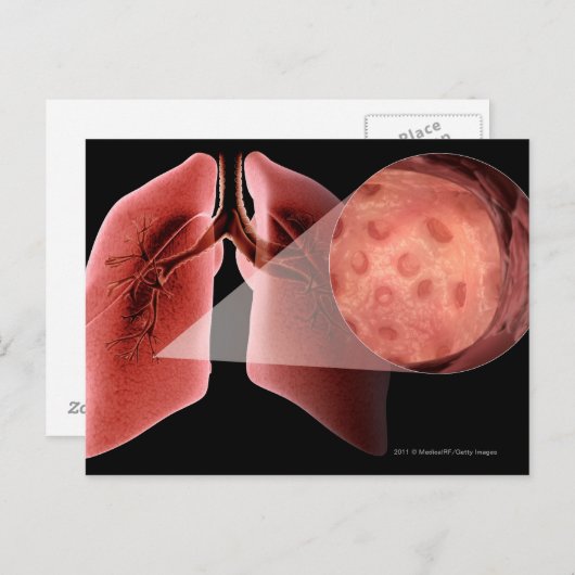 ぜんそく発作の間の気道の炎症 ポストカード (正面/裏面)