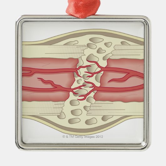 それ自身を修理する骨2 メタルオーナメント (正面)