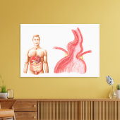 ～における裂孔ヘルニアの医学的虚脱 キャンバスプリント (インサイチュ (リビング))