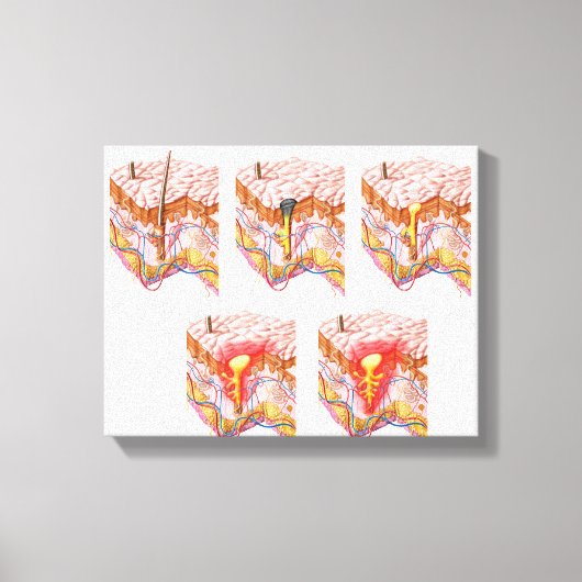 にきびの違う種類 キャンバスプリント (正面)