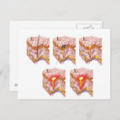 にきびの違う種類 ポストカード (正面/裏面)