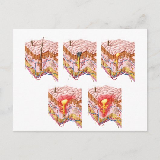 にきびの違う種類 ポストカード (正面)