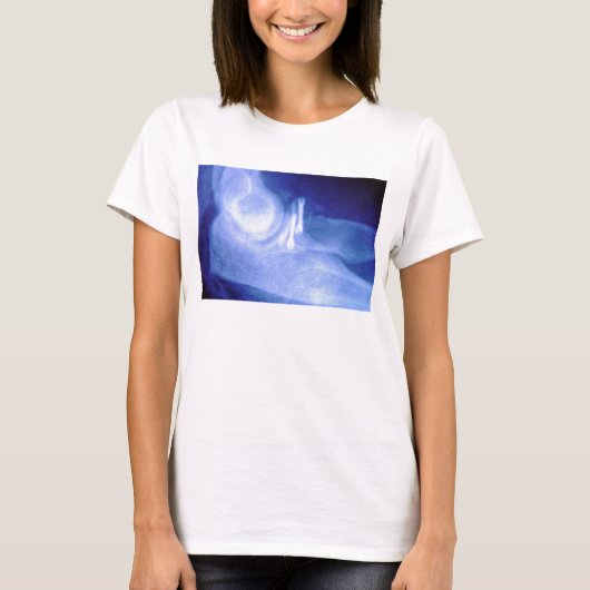 ねじが付いている肘のX線 Tシャツ (正面)