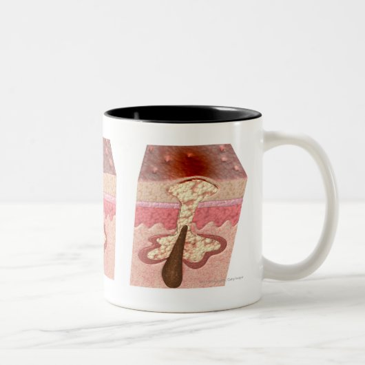 アクネを引き起こすものによりの眺め ツートーンマグカップ (右)