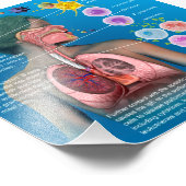 アレルギー： IgE炎症反応ポスター フォトプリント (角)