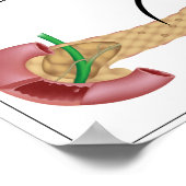 インスリン作用及び糖尿病1型及び2型ポスター ポスター (角)