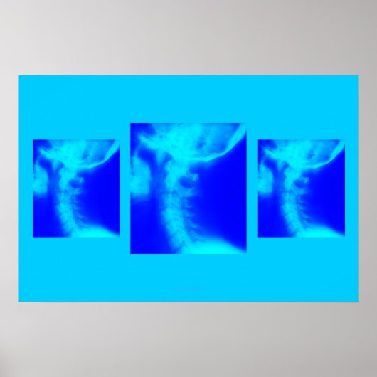 カイロプラクティックポスター:外側子宮頸部ブルース ポスター (正面)