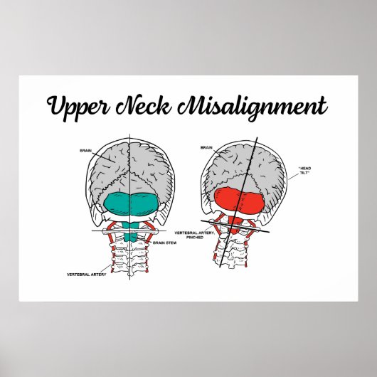 カイロプラクティック上頸部 ポスター (正面)