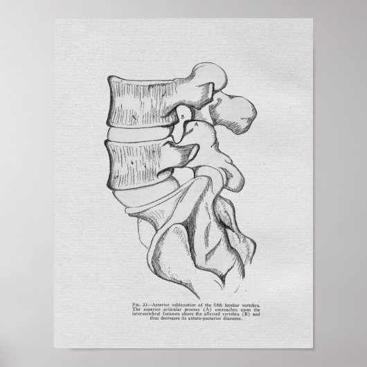 カイロプラクティック椎骨亜脱臼ヴィンテージプリント ポスター (正面)
