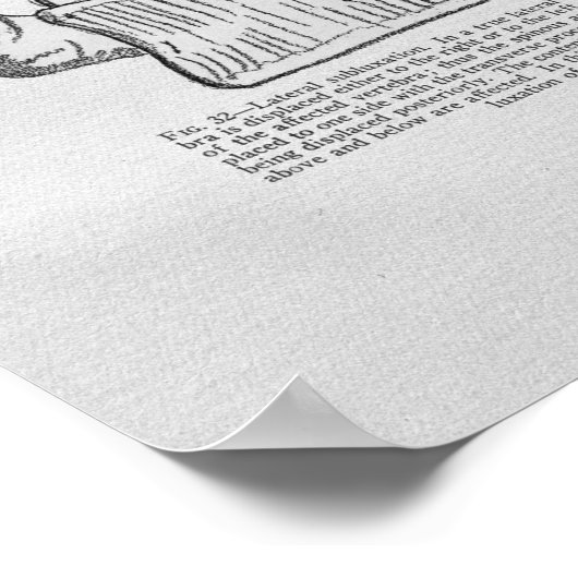 カイロプラクティック椎骨亜脱臼ヴィンテージプリント ポスター (角)