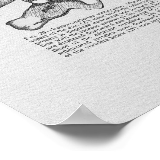 カイロプラクティック椎骨亜脱臼ヴィンテージプリント ポスター (角)