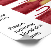 コレステロールプラークステージポスター ポスター (角)