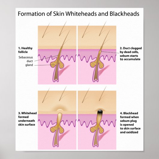 スキンブラックヘッドポスター ポスター (正面)