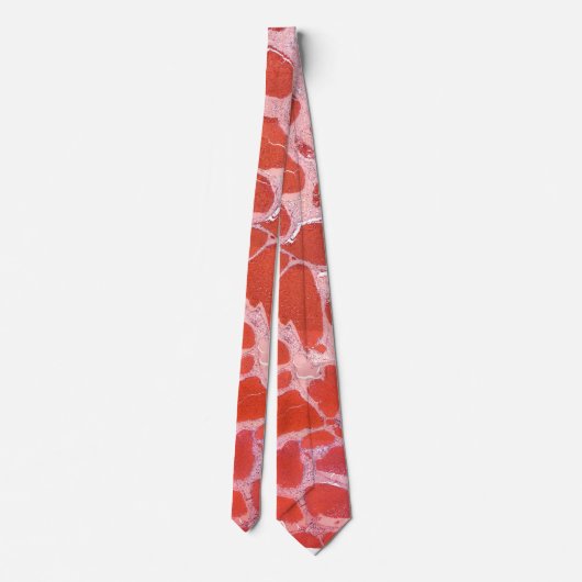 タイ血管腫の病理 ネクタイ (裏面)