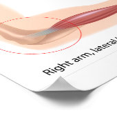 テニス肘スポーツ傷害ポスター ポスター (角)