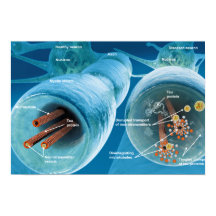 ニューロンの微小管の崩壊