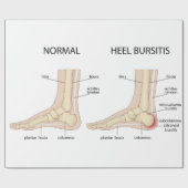 ハグルンド奇形 ラッピングペーパー (フラット)