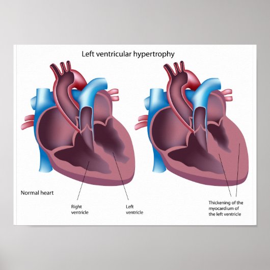 ハート肥大ポスター ポスター (正面)