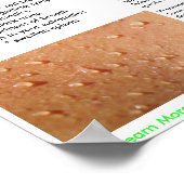 バベシア症状と伝染ポスター ポスター (角)