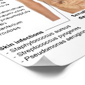 ヒトにおける細菌感染のポスター表 ポスター (角)