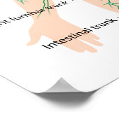 リンパ管ドレナージラベルのポスター ポスター (角)