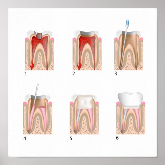 ルート運河トリートメント任意のサイズポスター ポスター (正面)