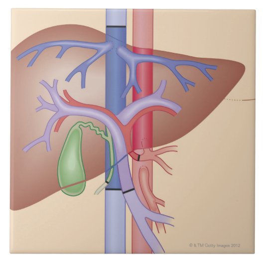レバー移植のプロシージャ タイル (正面)
