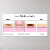 レーザー皮膚再表面化手順ポスター ポスター (正面)