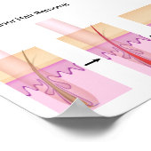 レーザー脱毛法 ポスター (角)