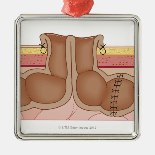 一時的なColostomy メタルオーナメント (正面)