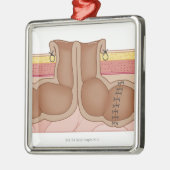 一時的なColostomy メタルオーナメント (左)