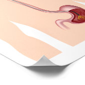 上部消化管内視鏡検査ポスター ポスター (角)