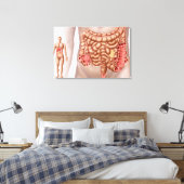 下行結腸管内憩室炎 キャンバスプリント (インサイチュ (寝室))