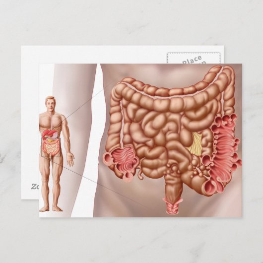 下行結腸管内憩室炎 ポストカード (正面/裏面)