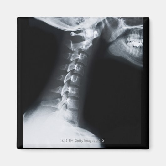 下顎を含む頸椎のX線 マグネット (正面)