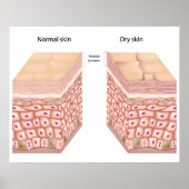乾燥肌ポスター ポスター (正面)