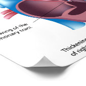 先天ハート病ポスター ポスター (角)