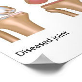 全膝置換手術ポスター ポスター (角)