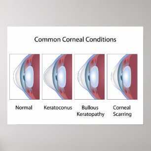 共通のcorneal条件ポスター ポスター