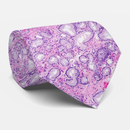 前立腺の腺癌 ネクタイ (ロール)