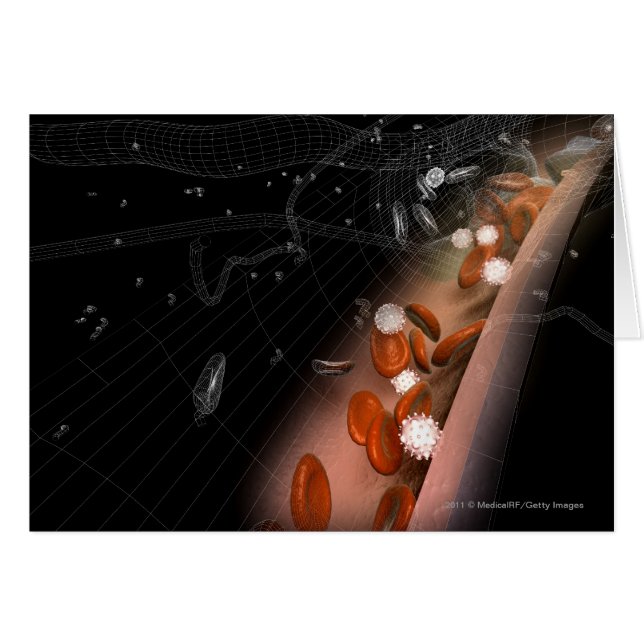 動脈のプラク (正面横)