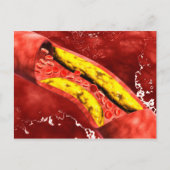 動脈の内部の脂肪斑の顕微鏡的見解 ポストカード (正面)