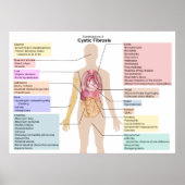 嚢胞性線維症の症状の図 ポスター (正面)