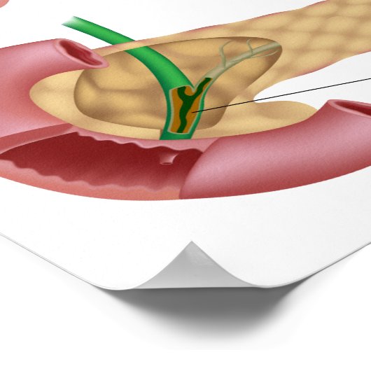 嚢胞性線維症ポスター ポスター (角)