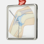 堅い内視鏡検査法のプロシージャ メタルオーナメント (左)