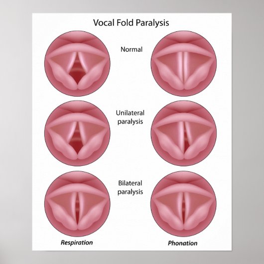 声帯まひポスター ポスター (正面)