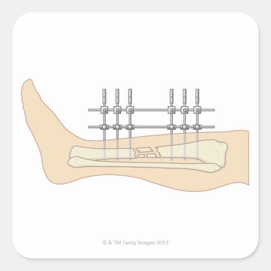 外付け固定具 スクエアシール (正面)