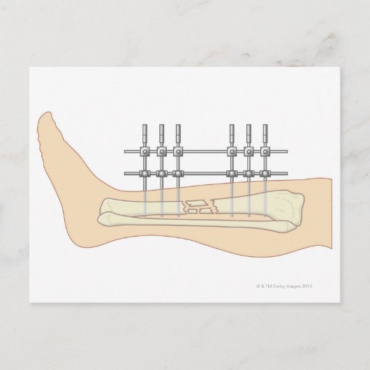 外付け固定具 ポストカード (正面)