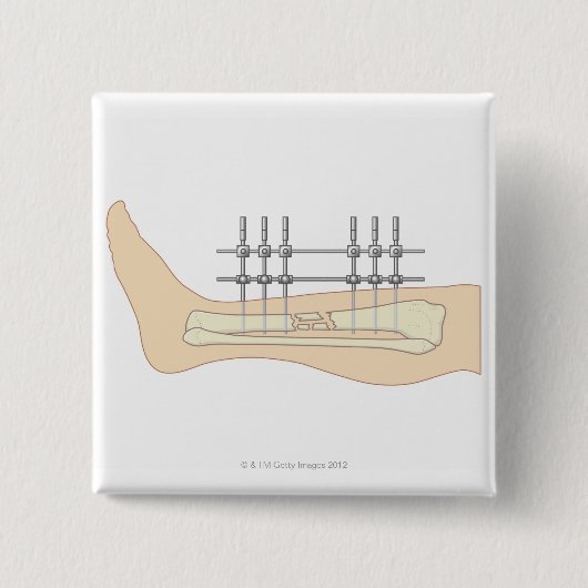 外付け固定具 缶バッジ (正面)